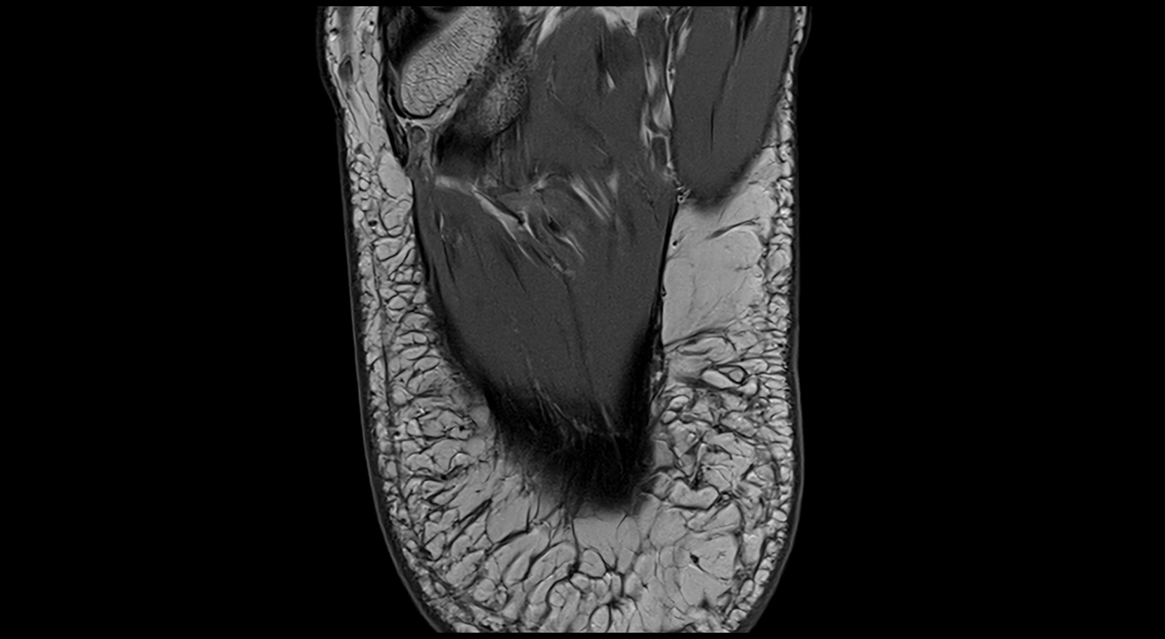 MRI ankle ligaments anatomy axial 3T image 29.webp